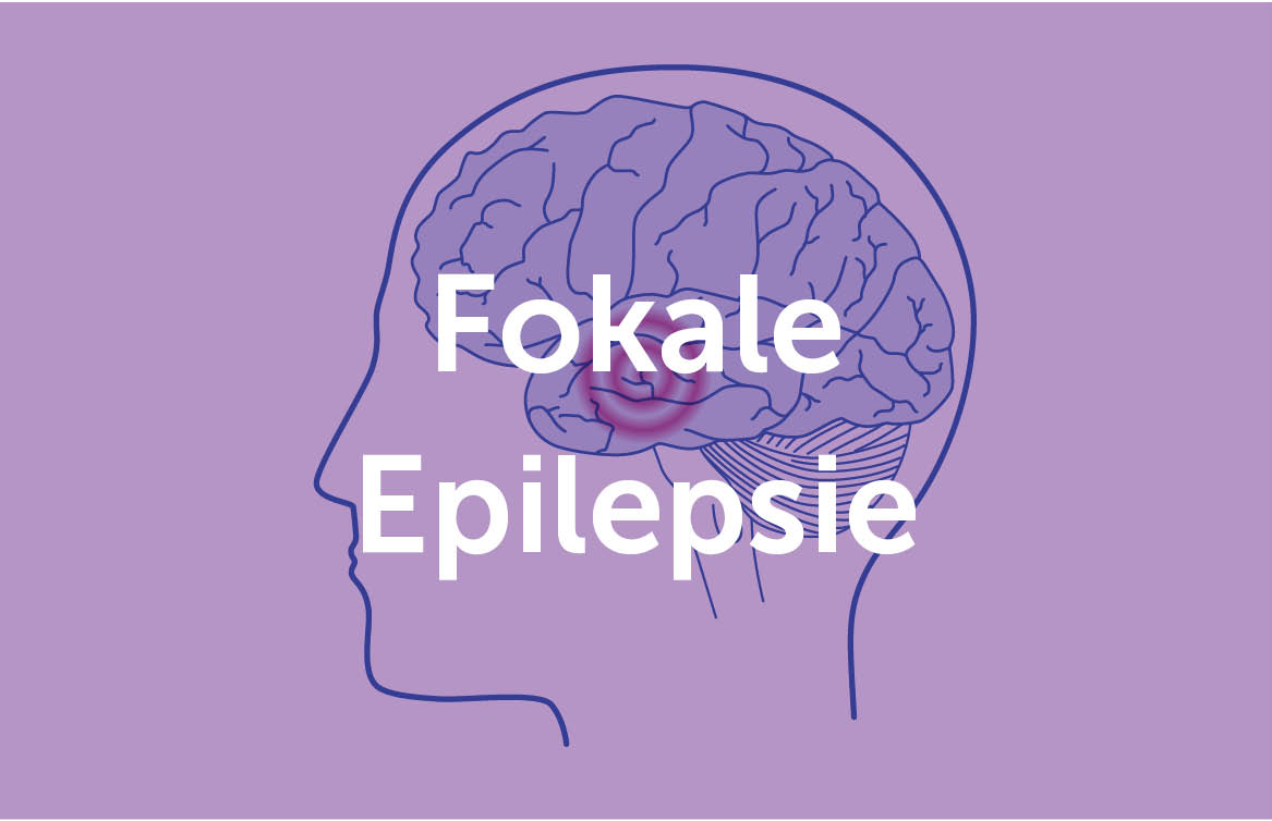 Illustration einer fokalen Epilepsie