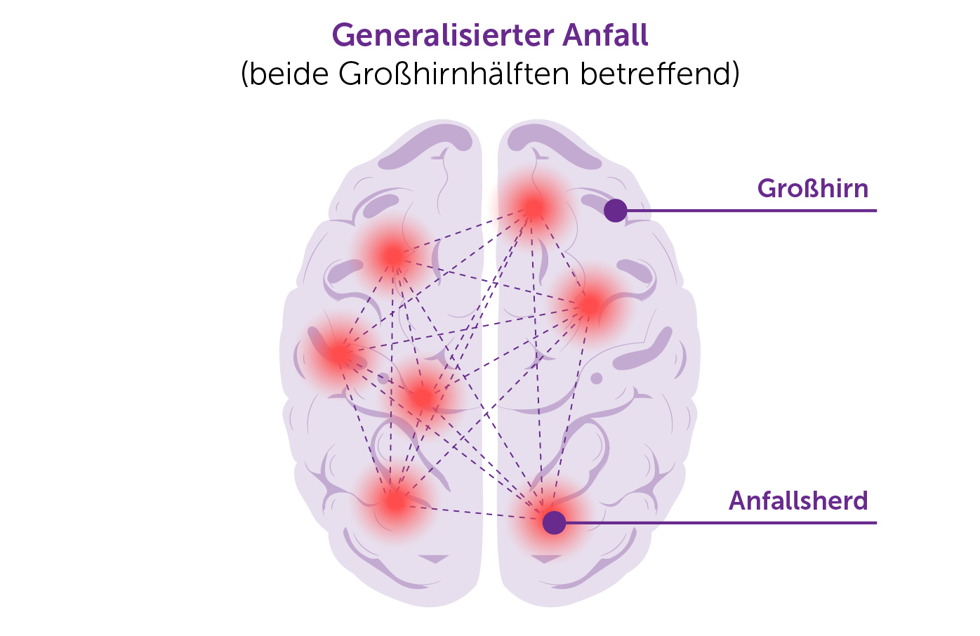 Illustration eines generalisierten Epilepsie-Anfalls im Gehirn