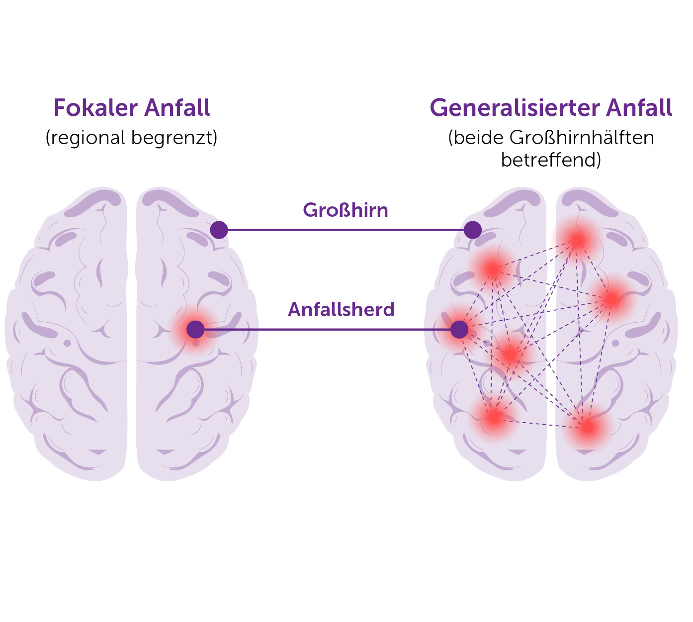Illustration eines fokalen und eines generalisierten Epilepsie-Anfalls im Gehirn
